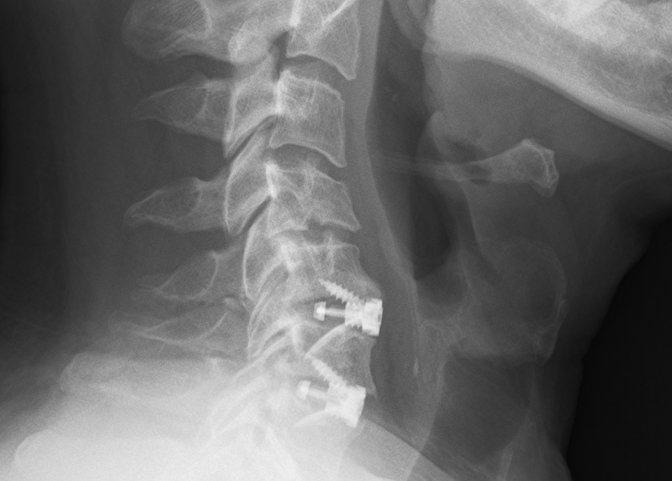 Anterior Cervical Discectomy & Fusion (ACDF) Surgery