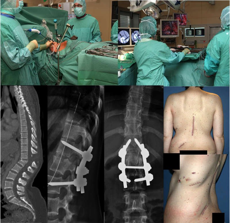 Fracture Spine Surgery In Nagpur