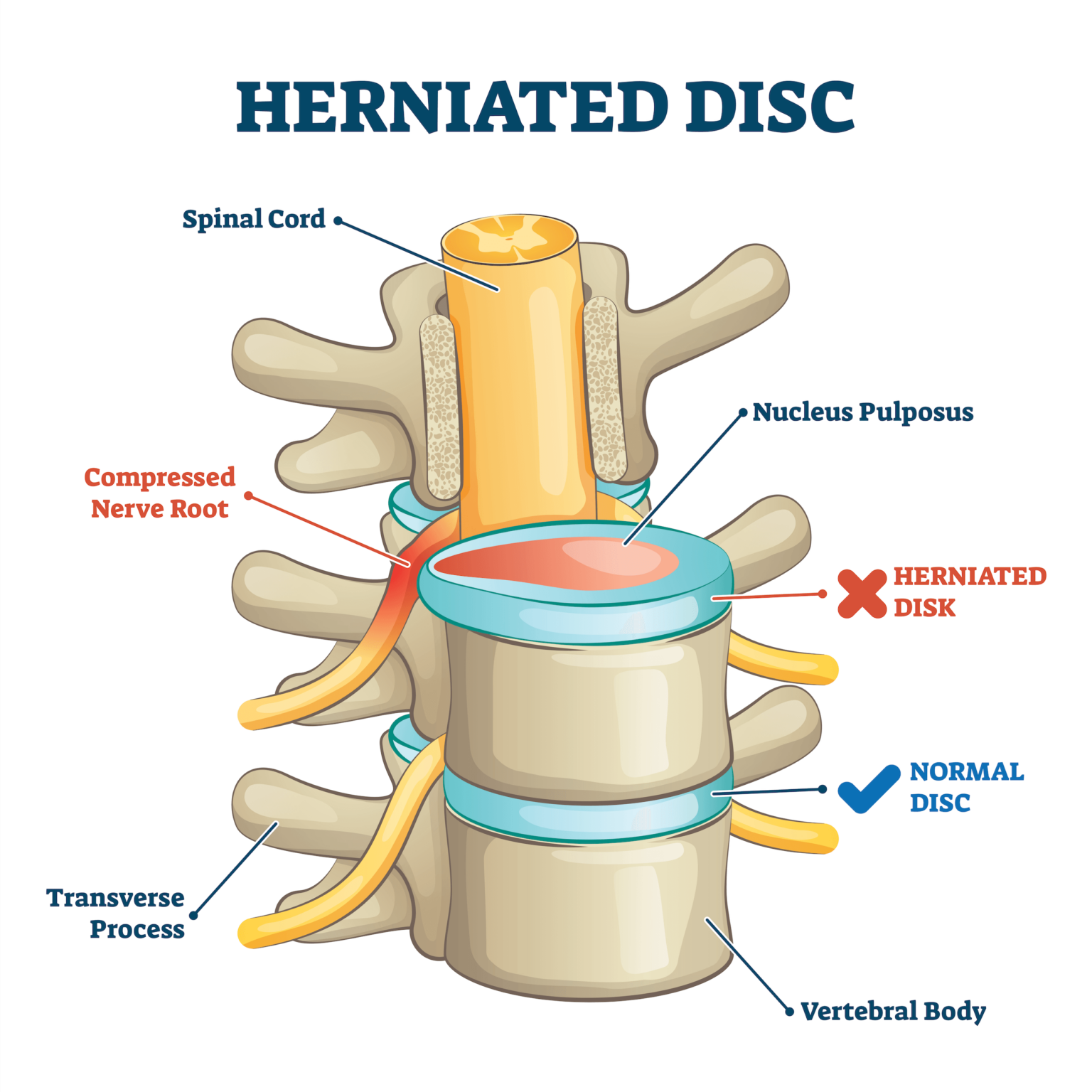 Herniated disc treatment Nagpur