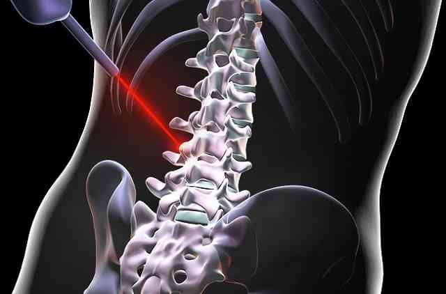 Laser Spine Surgery in nagpur