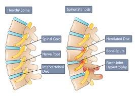 Lumbar canal stenosis Nagpur