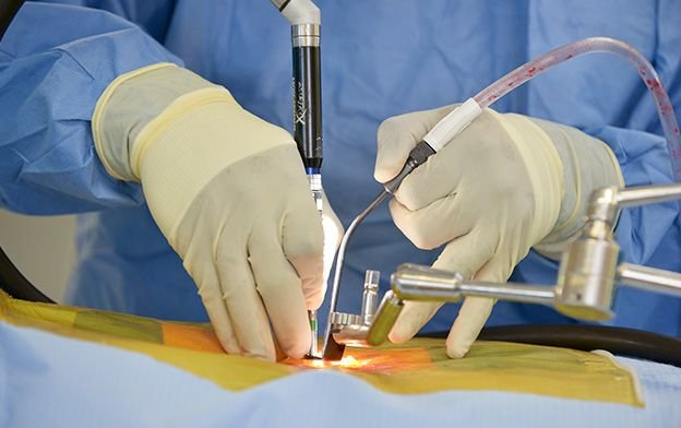 Minimally invasive spine surgery (MISS) is a state-of-the-art surgical method that has transformed the management of spinal pathologies.