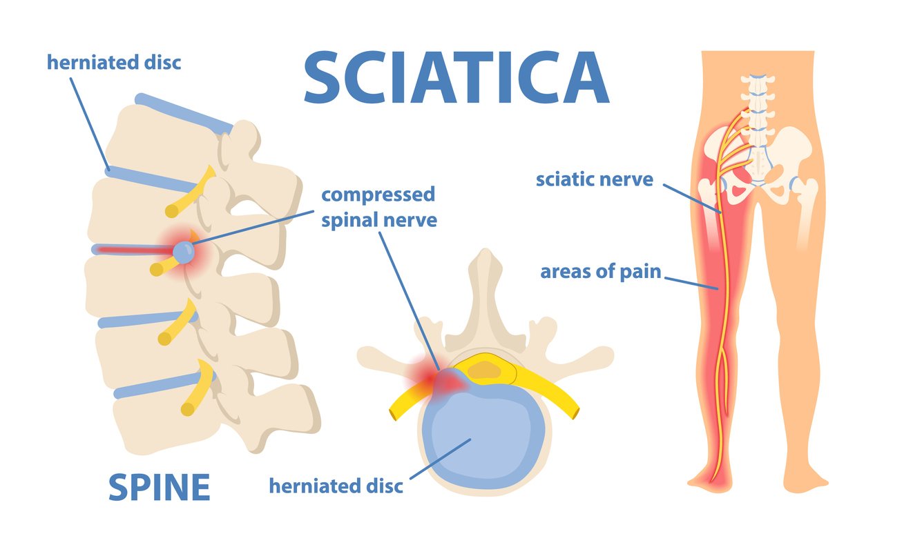 Sciatica treatment Nagpur
