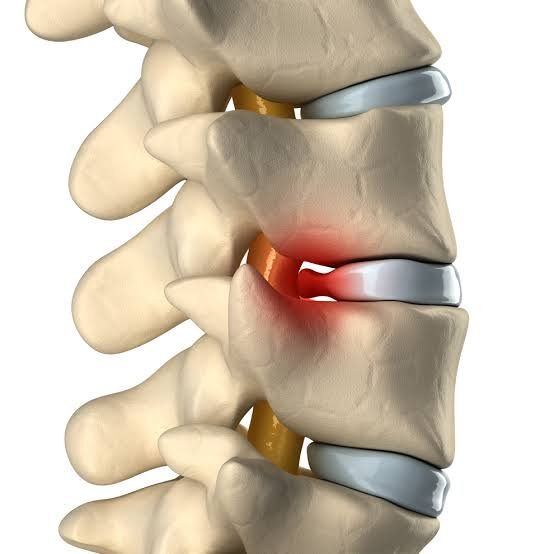Dr. Swapnil Sanjay Hajare is a renowned Orthopaedic Spine Surgeon in Nagpur, specializing in treating slip disc and other spine-related conditions.