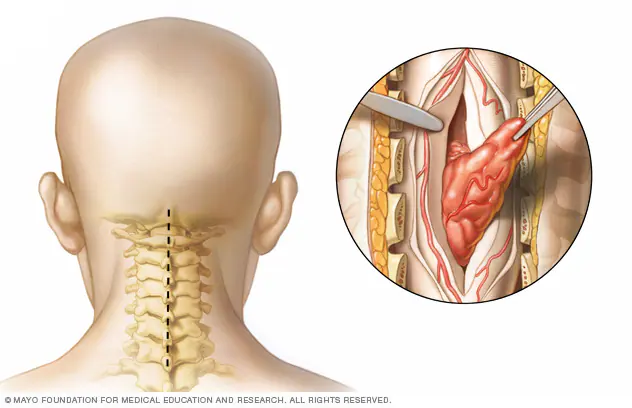 Spine Tumor Surgery