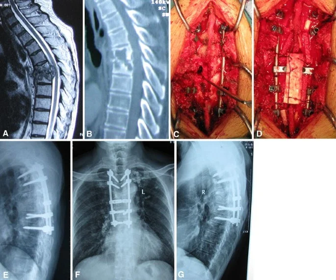 Tuberculosis Spine Surgery nagpur