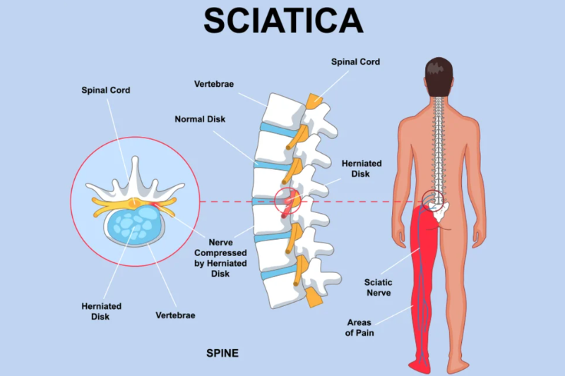 Sciatica Treatment and Surgery In Nagpur